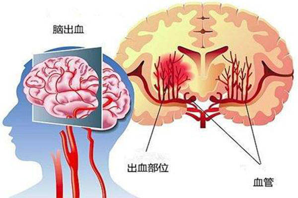 男子酒足饭饱后突发脑干出血,一场突如其来的健康警钟 男子酒足饭饱后突发脑干出血,一场突如其来的健康警钟
